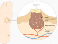 Копия Растяжение связок в сезон гололёда