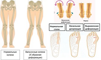 Лечение вальгусной деформации