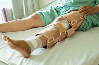Лечение закрытого перелома бедра