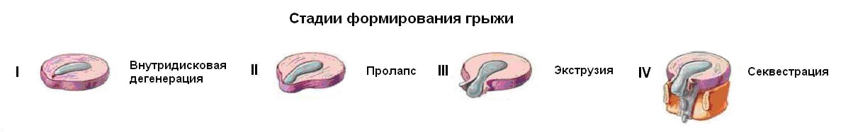 Стадии межпозвоночной грыжи