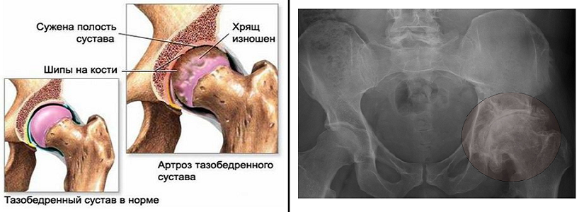 Артроз тазобедренного сустава