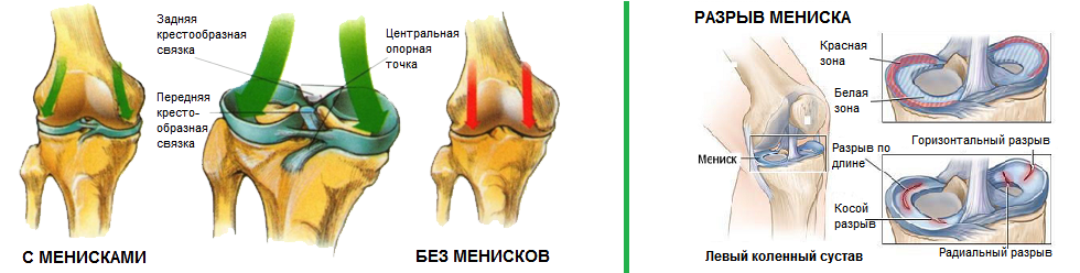Разрыв мениска коленного сустава. Мениск 3 степени коленного. Разрыв мениска коленного сустава рентген. Симптомы повреждения менисков коленного сустава.