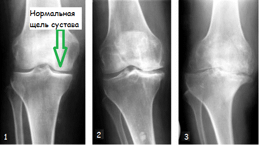 Стадии коленного артроза