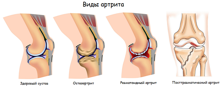 Виды артрита