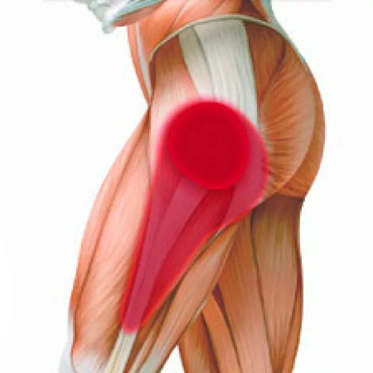Что такое тендиноз тазобедренного сустава