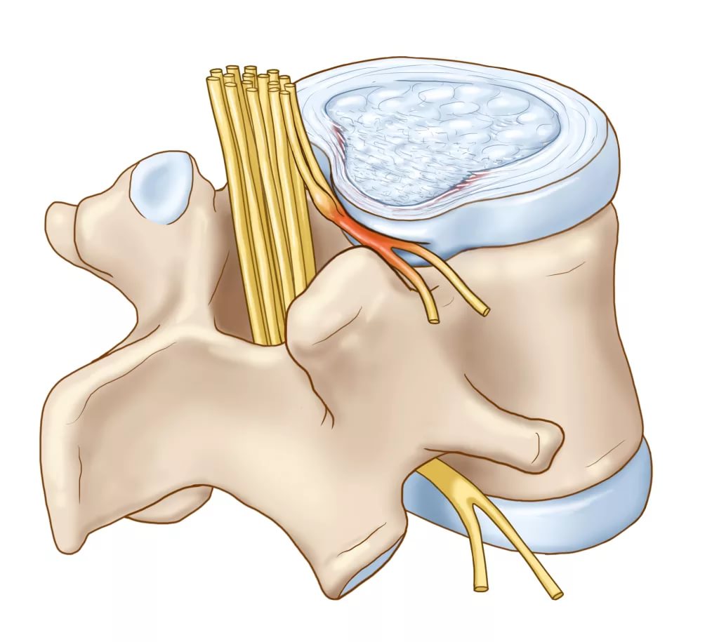 Протрузия межпозвоночного диска
